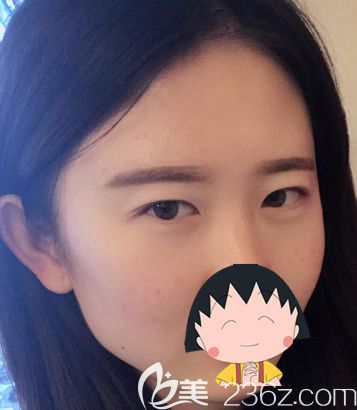 包头华美整形医院割双眼皮前 包头华美整形医院割双眼皮前