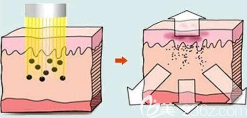 上海光博士医疗美容门诊部彭春激光去色素原理
