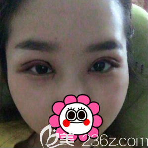 乔爱军医生给我做开眼角切开双眼皮第二天样子