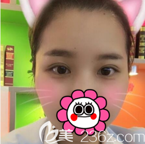 在北京京韩做切开双眼皮开眼角一月效果