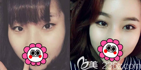 北京京韩开眼角切开双眼皮案例