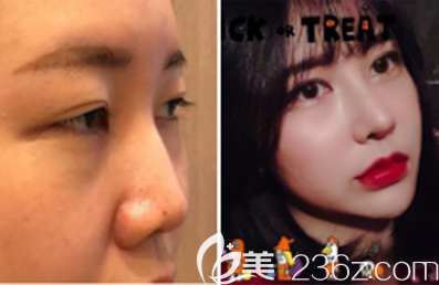 韩国Glory整形外科姜车荣鼻综合隆鼻案例效果对比图