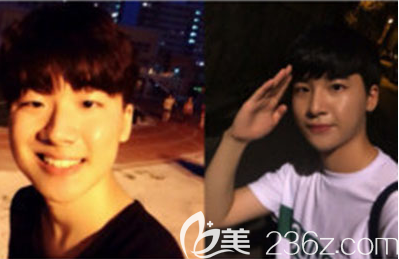 韩国Glory整形医院男士隆鼻手术效果图