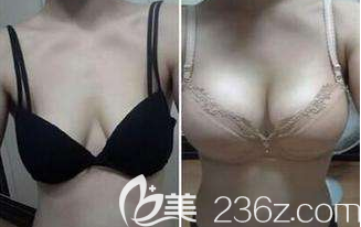 韩国Glory整形蓓拉假体隆胸真实案例效果对比图 韩国Glory整形蓓拉假体隆胸真实案例效果对比图