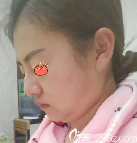 永康光大整形做光纤溶脂瘦脸前 永康光大整形做光纤溶脂瘦脸前