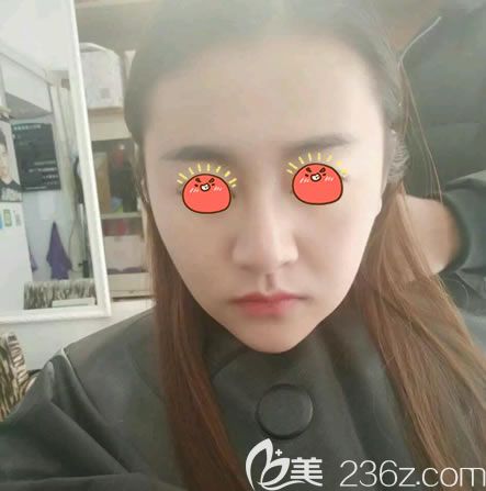 永康光大光纤溶脂瘦脸15天照片 永康光大光纤溶脂瘦脸15天照片