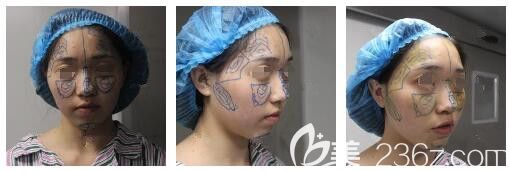 面诊南通俪人连天美医生术前划线设计 面诊南通俪人连天美医生术前划线设计