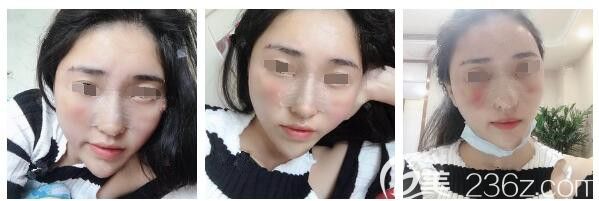 做完脂肪填充+隆鼻术后五天恢复 做完脂肪填充+隆鼻术后五天恢复