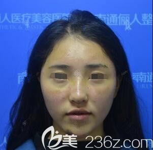 术后一周到医院复查面部恢复情况 术后一周到医院复查面部恢复情况