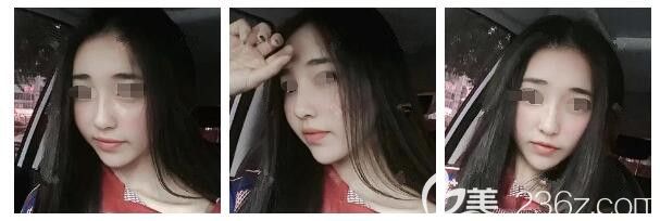 二次脂肪填充术后半个月恢复情况 二次脂肪填充术后半个月恢复情况