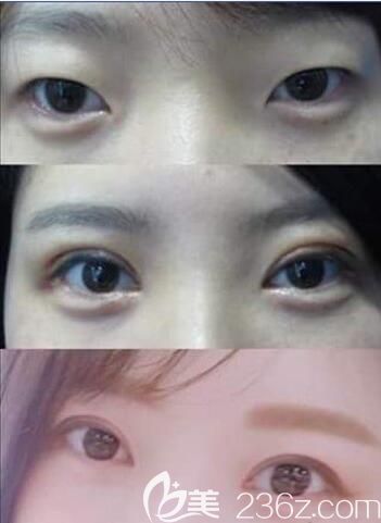 韩国蜡笔Crapas整形外科郑美善韩式无痕双眼皮案例恢复过程图 韩国蜡笔Crapas整形外科郑美善韩式无痕双眼皮案例恢复过程图