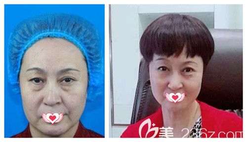 天伊美整形医院做埋线提升案例 天伊美整形医院做埋线提升案例