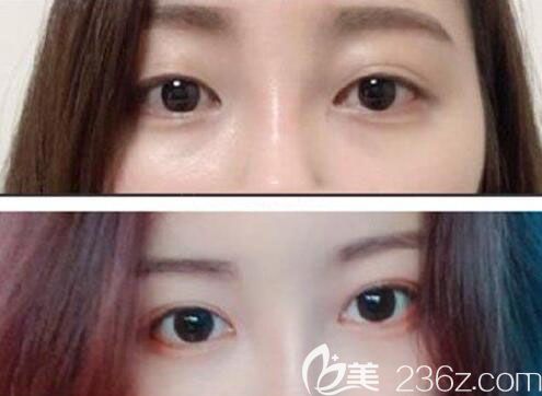 韩国Crapas蜡笔整形外科郑美善双眼皮案例 韩国Crapas蜡笔整形外科郑美善双眼皮案例