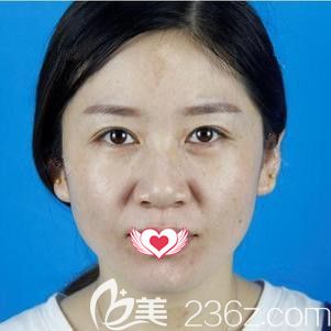 在石家庄天伊美做激光祛斑前拥有大量黄褐斑 在石家庄天伊美做激光祛斑前拥有大量黄褐斑