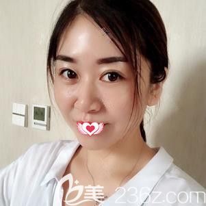 在石家庄天伊美做皮秒祛斑后色斑减轻 在石家庄天伊美做皮秒祛斑后色斑减轻