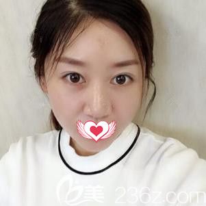 张斌医生为我做激光祛斑后10天色斑完全消除 张斌医生为我做激光祛斑后10天色斑完全消除