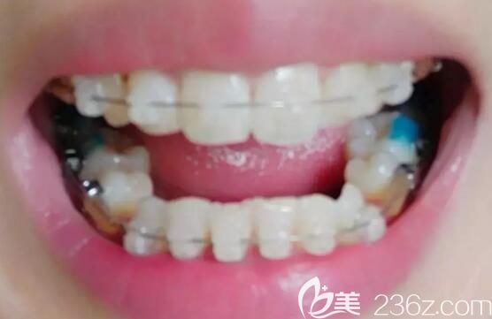我在维乐口腔做陶瓷托槽牙齿矫正第6个月