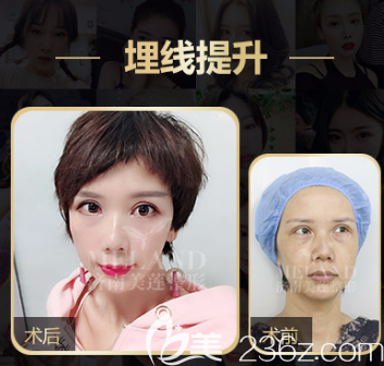 埋线提升的案例