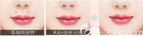 韩国MVP整形M唇整形