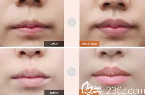 韩国MVP唇部整形案例