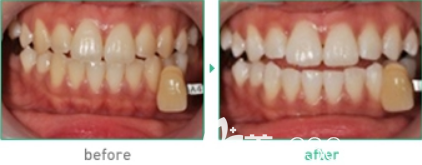 韩国江南延世泉牙科医院牙齿美白案例效果前后对比图