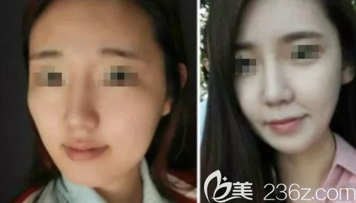 <!--<i data=20240703-sp></i>-->王侠下颌角整形前后对比照片 <!--<i data=20240703-sp></i>-->王侠下颌角整形前后对比照片