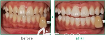 韩国江南延世泉牙科医院牙齿美白案例效果对比图