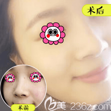 北京壹加壹李凤苔医生激光点痣案例