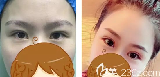西安整形医生张沙沙双眼皮案例 西安整形医生张沙沙双眼皮案例