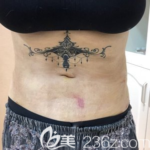 <i data-id='8cb641b3-5c99-43b6-9d58-783ebde4edf3' style='display:none;'></i>腰腹吸脂拆线后效果 <i data-id='8cb641b3-5c99-43b6-9d58-783ebde4edf3' style='display:none;'></i>腰腹吸脂拆线后效果