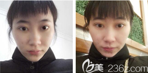 李正鹏激光祛斑术后一周