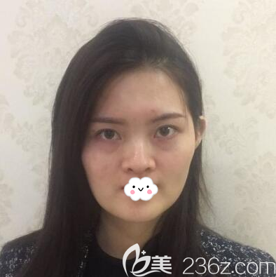 在<i data-id='2f3b027c-7adc-4bed-aa61-5d9313a5a76d' style='display:none;'></i>做鼻综合术前照片 在<i data-id='2f3b027c-7adc-4bed-aa61-5d9313a5a76d' style='display:none;'></i>做鼻综合术前照片