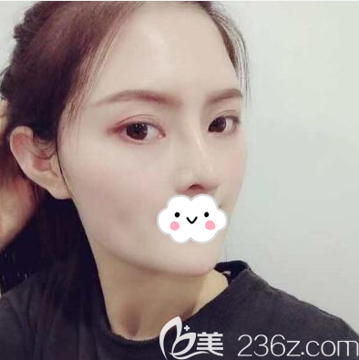 肋软骨隆鼻拆线后侧脸效果图 肋软骨隆鼻拆线后侧脸效果图