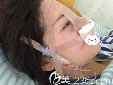 <i data-id='2f3b027c-7adc-4bed-aa61-5d9313a5a76d' style='display:none;'></i>杨勇肋软骨隆鼻术后即刻 <i data-id='2f3b027c-7adc-4bed-aa61-5d9313a5a76d' style='display:none;'></i>杨勇肋软骨隆鼻术后即刻