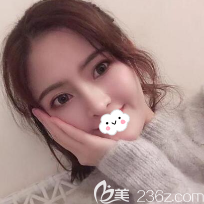 <i data-id='2f3b027c-7adc-4bed-aa61-5d9313a5a76d' style='display:none;'></i>鼻综合术后45天效果图 <i data-id='2f3b027c-7adc-4bed-aa61-5d9313a5a76d' style='display:none;'></i>鼻综合术后45天效果图