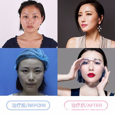 整形医院超皮秒祛斑案例 整形医院超皮秒祛斑案例