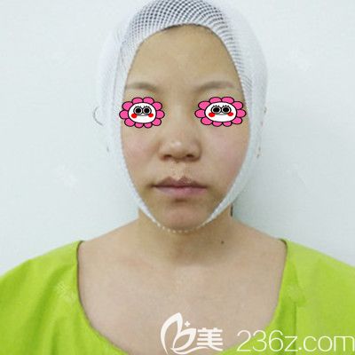 刚做完面部<span style= 刚做完面部<span style=