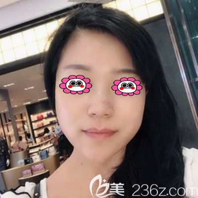 埋线提升第15天<span style= 埋线提升第15天<span style=