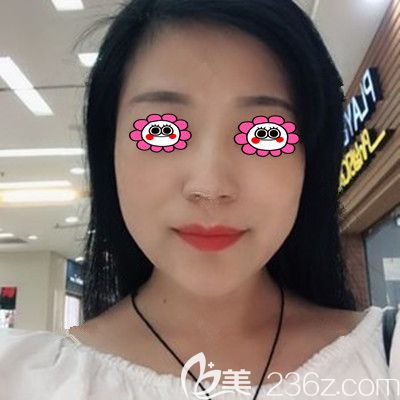 在湘潭雅美做完线雕的第三个月，趁着五一整形价格优惠又定了面部脂肪填充项目