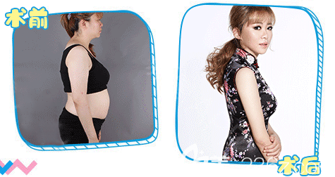 整形医院吸脂案例 整形医院吸脂案例