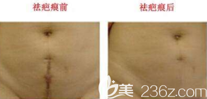 剖腹产疤痕能消除吗?韩国激光祛疤痕案例图 剖腹产疤痕能消除吗?韩国激光祛疤痕案例图