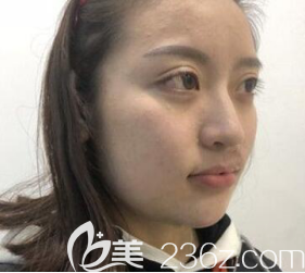 术前我的脸胖乎乎的 术前我的脸胖乎乎的