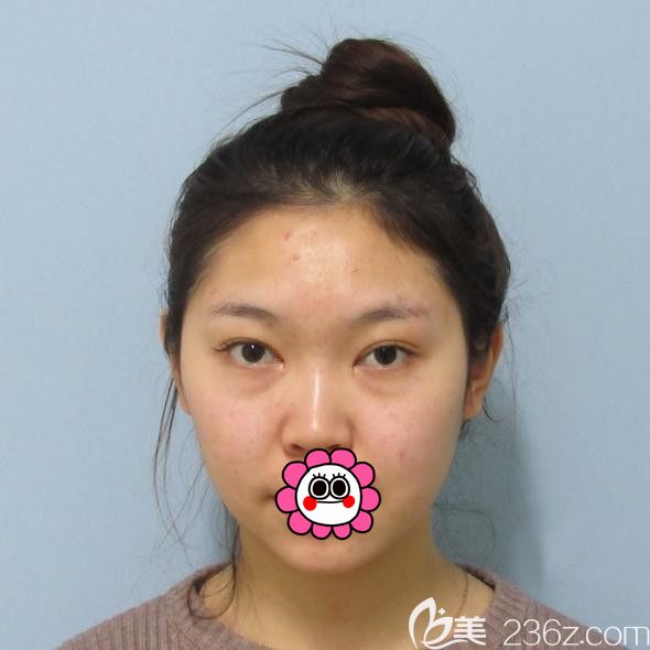 哈尔滨索菲硅胶垫下巴前 哈尔滨索菲硅胶垫下巴前