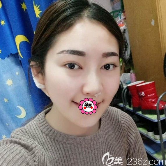 硅胶垫下巴一周拆线后效果 硅胶垫下巴一周拆线后效果