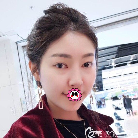 哈尔滨索菲硅胶隆下巴一个月效果 哈尔滨索菲硅胶隆下巴一个月效果