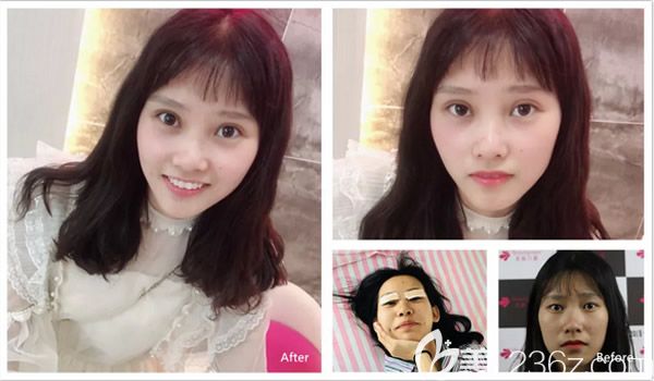 俞静医生双眼皮修复案例展示 俞静医生双眼皮修复案例展示