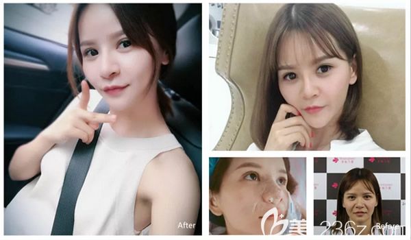 俞静医生假体隆鼻修复案例对比 俞静医生假体隆鼻修复案例对比