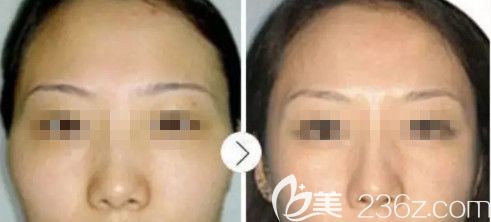 衡水唯美注射玻尿酸丰太阳穴案例