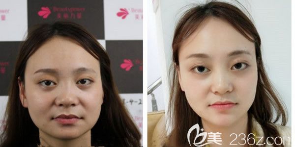 瘦脸除皱瘦脸+玻尿酸填充下巴后7天案例 瘦脸除皱瘦脸+玻尿酸填充下巴后7天案例