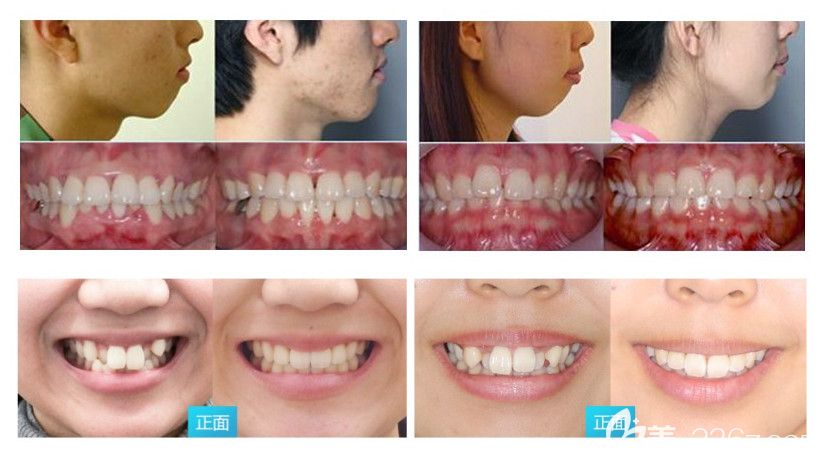 深圳拜尔口腔深覆合矫正和虎牙矫正案例图 深圳拜尔口腔深覆合矫正和虎牙矫正案例图